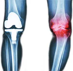 Diagnose Arthrose